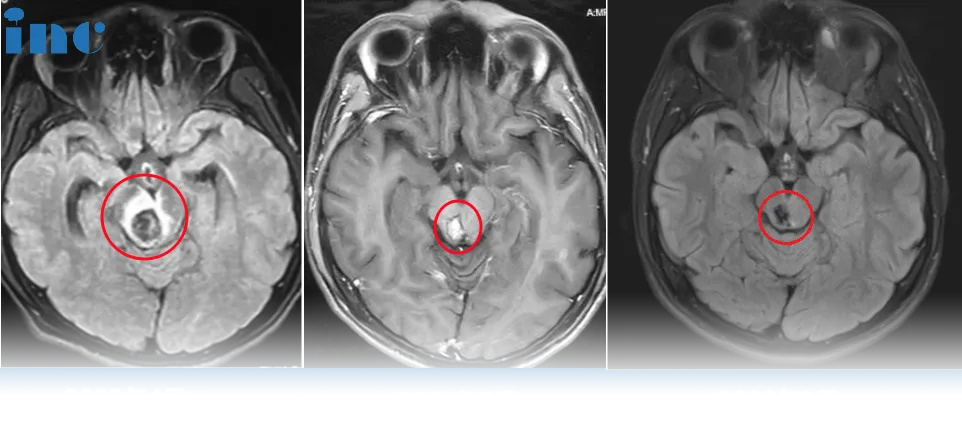 脑干血管畸形案例：“脑干出血没有希望，动不了手术”——看他如何勇敢选择、逆风翻盘！