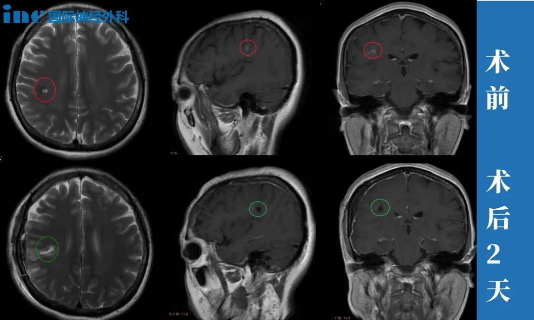 47岁女性?半卵圆中心海绵状血管瘤