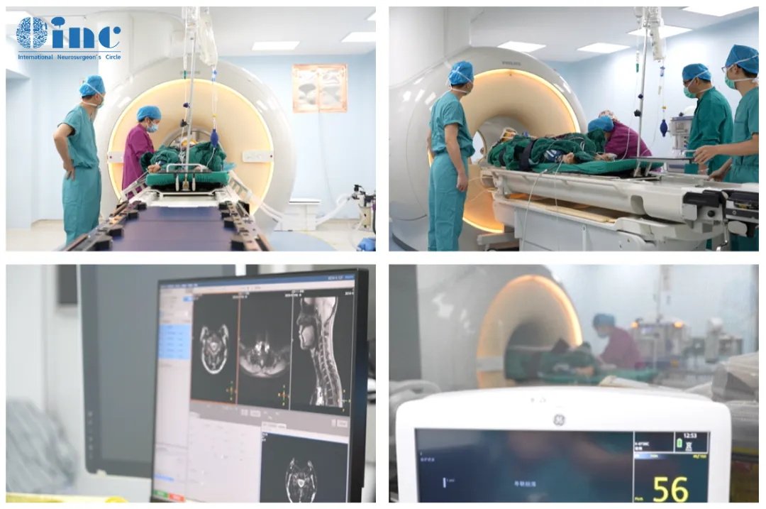 功能区胶质瘤使用术中核磁能够确定较大水平顺利切除肿瘤