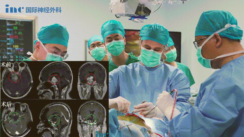 罕见巨大脊索瘤多次复发手术  　　INC福洛希教授安全术后10个月恢复如何？
