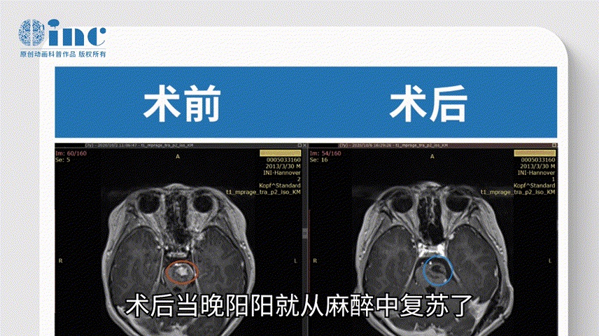 巴特朗菲教授——脑海绵状血管瘤案例