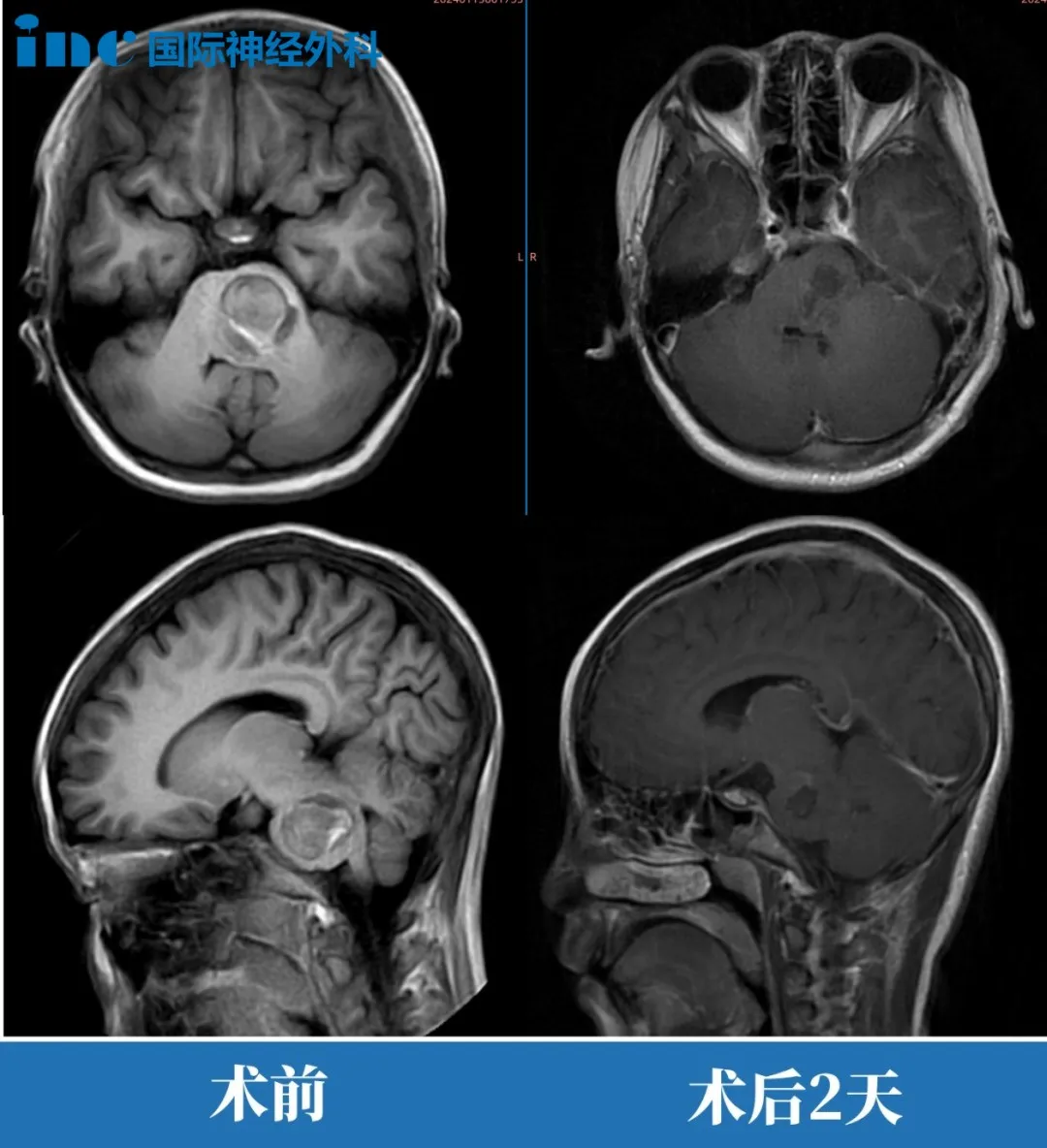 7岁女孩果果——脑干中脑海绵状血管瘤案例