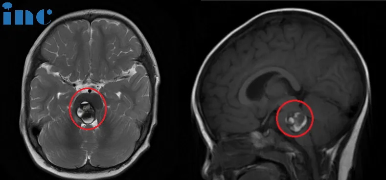 术前：脑桥占位。双眼斜视、畏光，面瘫，频发不自主扭头动作，走路稍有不稳。头颅MR(红色区域)显示:脑桥血肿，可见16 x 22 x 21mm肿块，四脑室受压变窄。