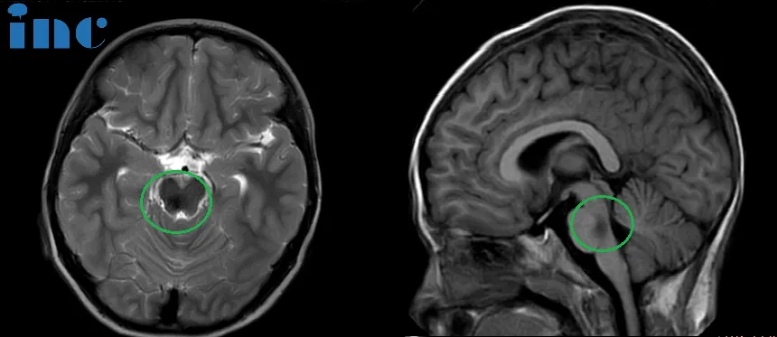 术后：头颅MR(蓝色区域)显示小脑半球及脑干形态正常，中线结构居中，原脑桥内团块状信号消失。