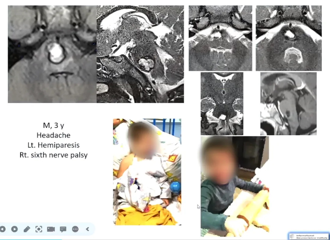 3岁男孩，轻度偏瘫六神经麻痹。顺利全切