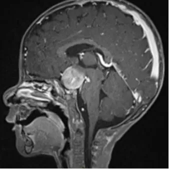 视神经<a href='/bingzhong/jiaozhiliu/' target='_blank'><u>胶质瘤</u></a>