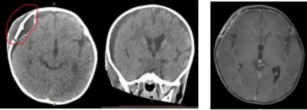 视神经胶质瘤影像