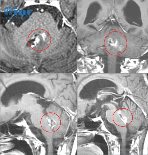 四脑室肿瘤可以顺利全切吗？