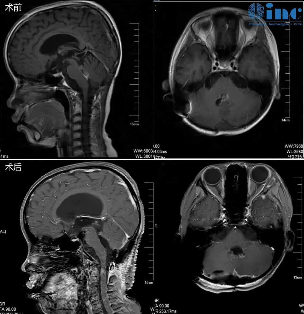在苏州大学附属儿童医院，巴教授已经顺利为周周顺利完成手术，顺利全切四脑室肿瘤