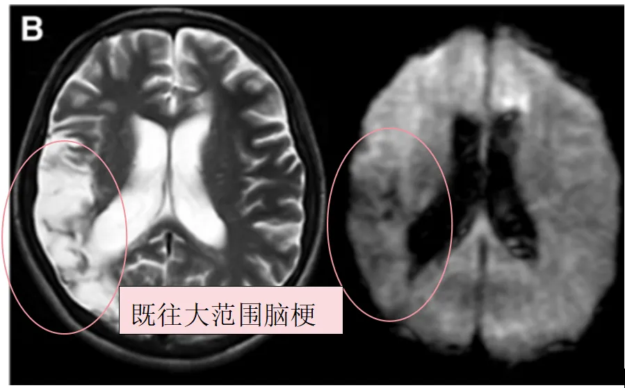 B,术前T2、DWI序列显示入院前1个月显示，既往右侧额顶叶脑梗死。