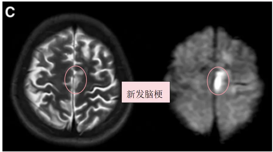 C,术前T2、DWI序列显示左额叶新发展的脑梗死。