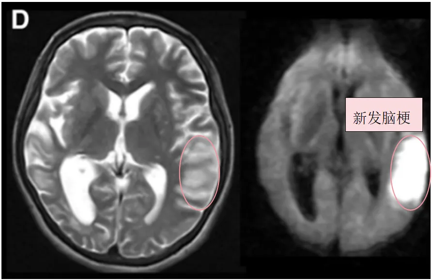 D,入院3天后术前T2、DWI序列显示左侧颞叶进一步新发脑梗死