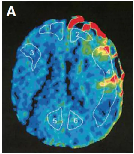 A，术后Xe-CT显示左侧大脑中动脉区域明显血流灌注(局部脑血流量:26.8 ml/100 g/min)，血管通畅。