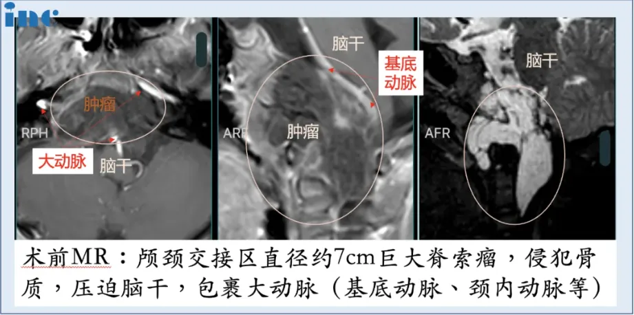 6岁男孩较大颅底脊索瘤