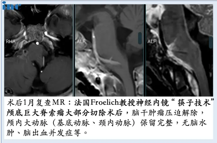 6岁男孩较大颅底脊索瘤