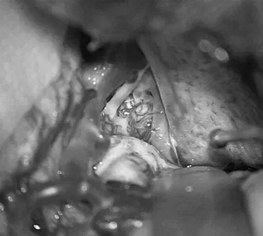 右侧眶颧开颅，经侧裂入路，牵开颞较暴露来自ICA鞍上段、MCA的M1段、PCA的P2段和小脑幕切迹。