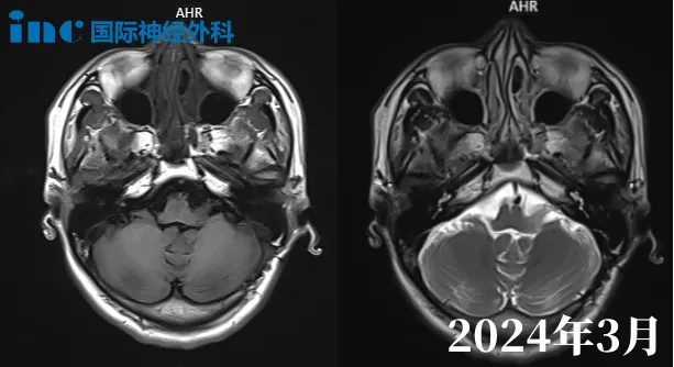 49岁小脑半球-脑桥占位性病变患者影像