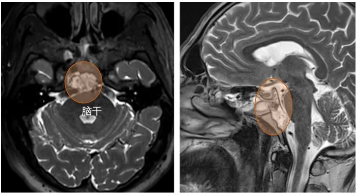 Alex术前磁共振MRI显示斜坡脊索瘤，向上、中斜坡延伸侵犯颅神经。