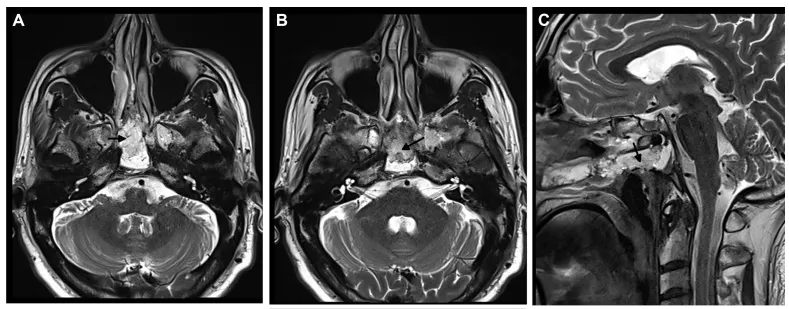 图5：术后轴位A,B和矢状C t2加权MRI显示肿瘤切除，脂肪用于重建。