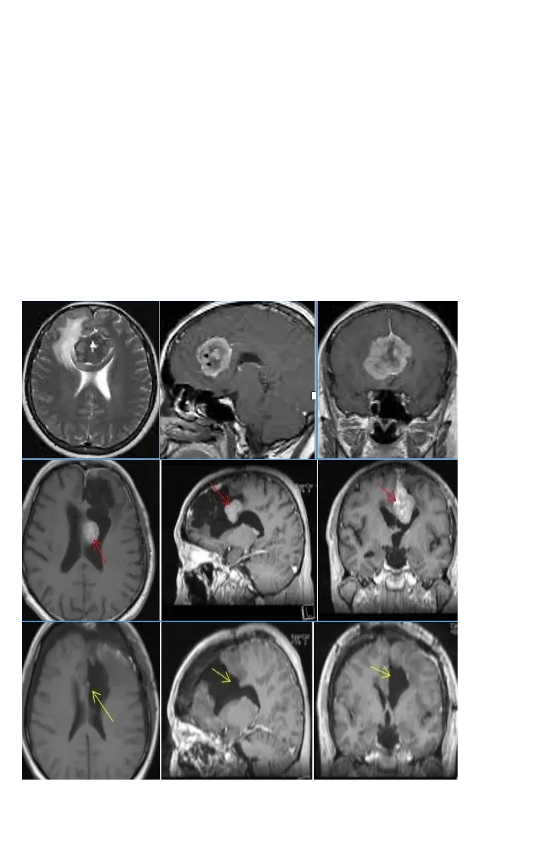 手术实现脑膜瘤Simpson 1级切除