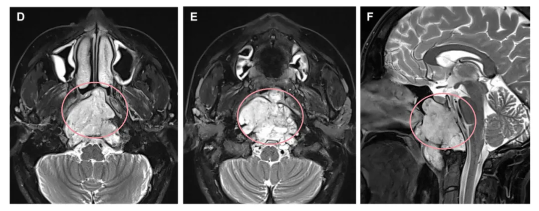 D、E术前轴向和F矢状t2加权MRI