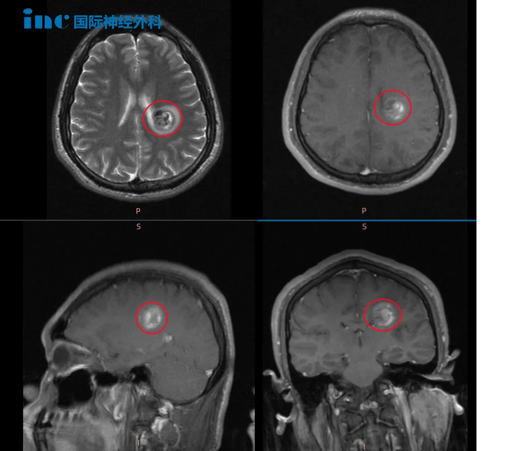 2022年5月MRI影像，血管畸形处于急性出血期