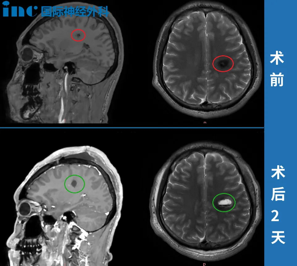 术前术后MRI影像对比