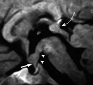 3岁女童,中枢性尿崩症。矢状位增强T1加权磁共振成像显示一个清晰的、分叶的、均匀增强的肿块(生殖细胞瘤),累及垂体柄近端（直箭头）和下丘脑底部(箭头)。还可见松果体相关的生殖细胞瘤(弯箭头)。术后诊断下丘脑和松果体异体生殖细胞瘤