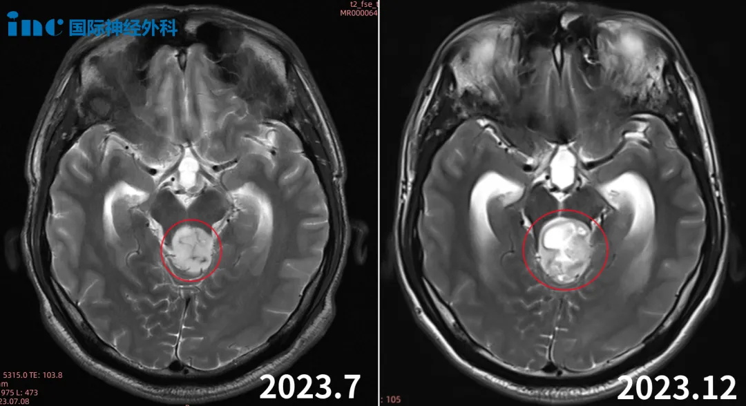 2024年1月10日，巴教授率领国内团队共同的努力下，手术取得了成功。