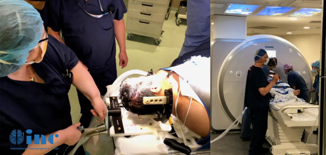 国际儿童脑瘤教授INC Rutka教授