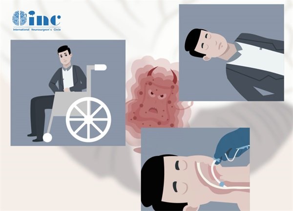 脊髓胶质瘤四级会不复发吗?还要复查吗?