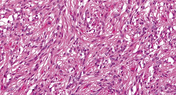 在大多数血管中心性胶质瘤中发现了具有双较细胞质突起的伸长细胞,是在肿瘤的实性区域。