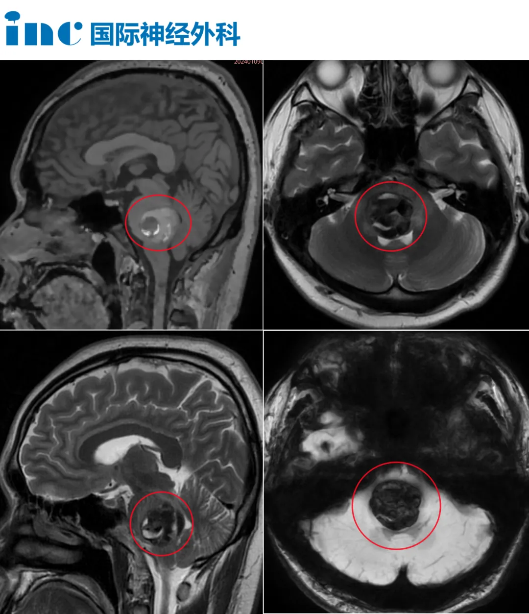 症状减轻就“扛一扛”？脑干海绵状血管瘤突发出血仅10天，他竟然……