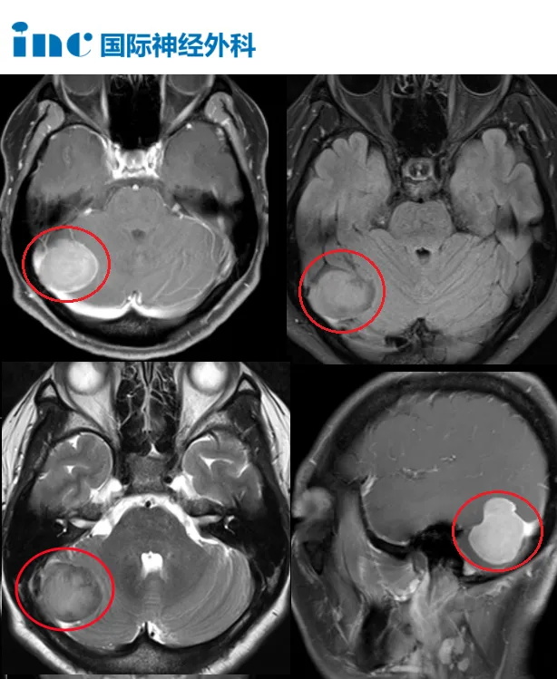 天坛医院联合INC国际教授手术纪实——较大天幕脑膜瘤案例