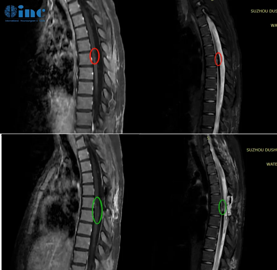 术后两个月时，田田正在康复医院进行康复训练