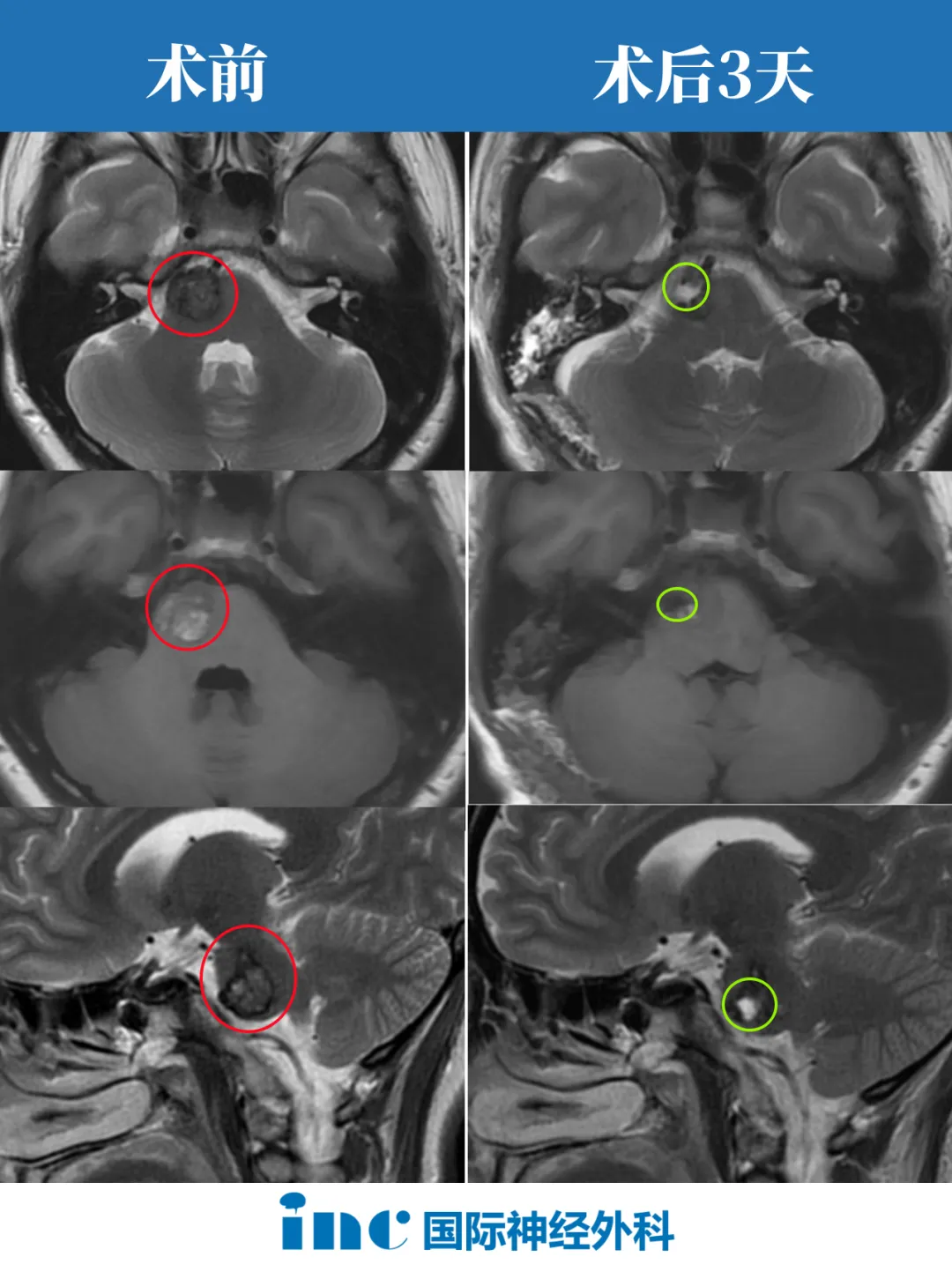脑干海绵状血管瘤成功案例术后影像对比
