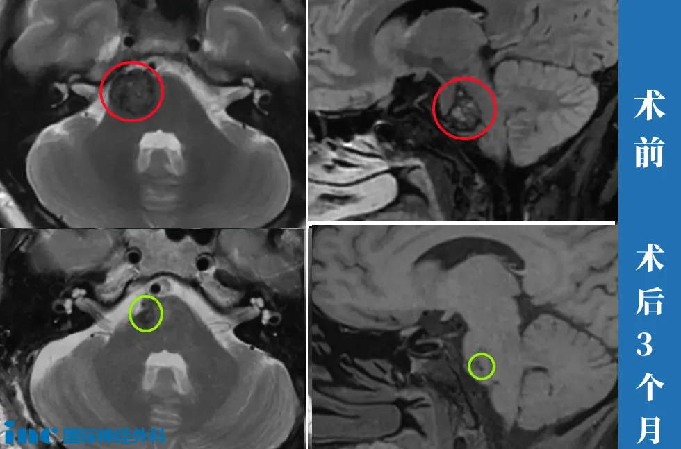 37岁女性—脑干海绵状血管瘤