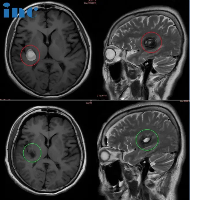 37岁女性—脑干海绵状血管瘤