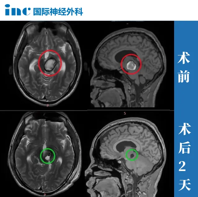 18岁男孩—脑干海绵状血管瘤