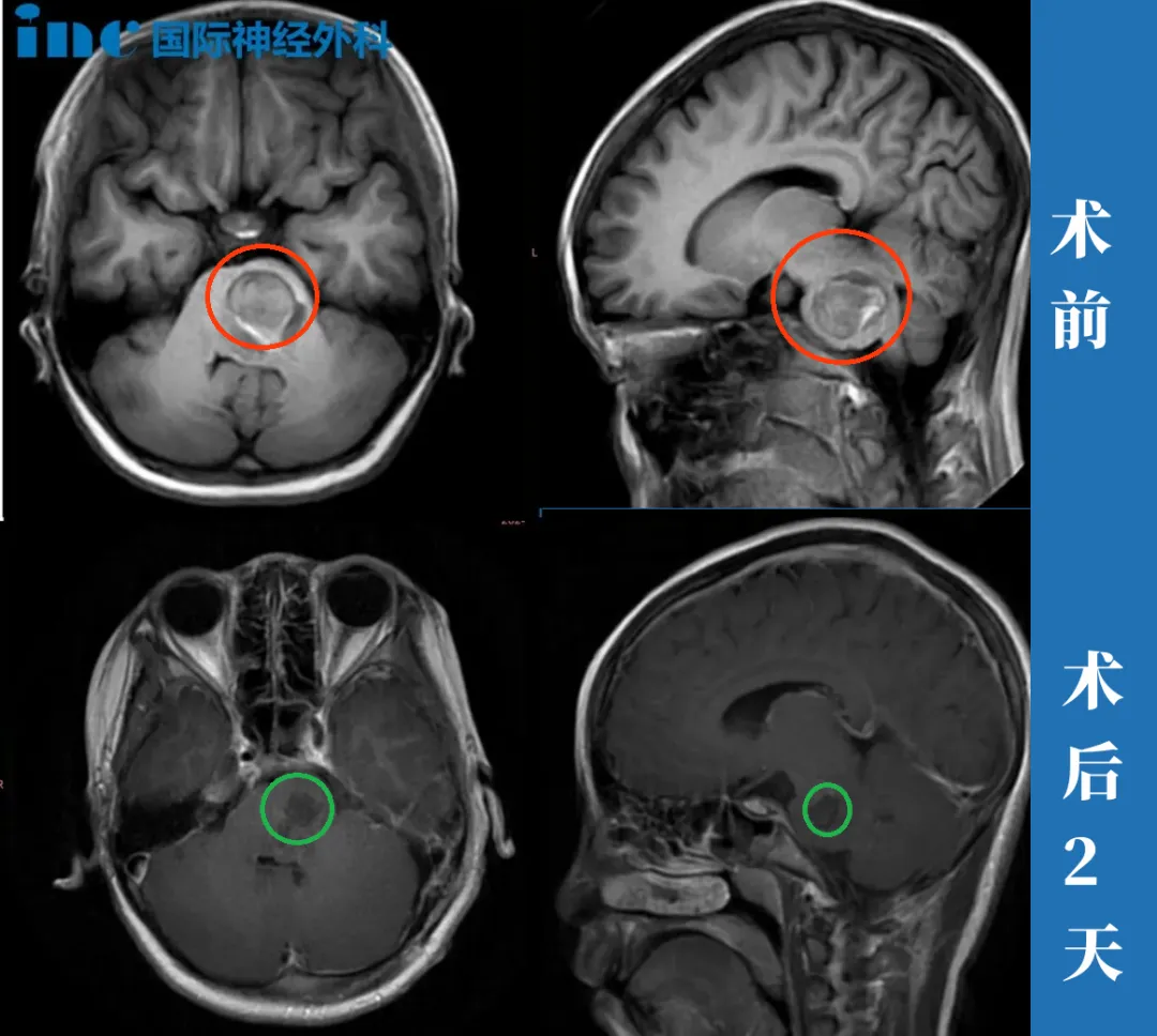 12岁女孩—脑干海绵状血管瘤