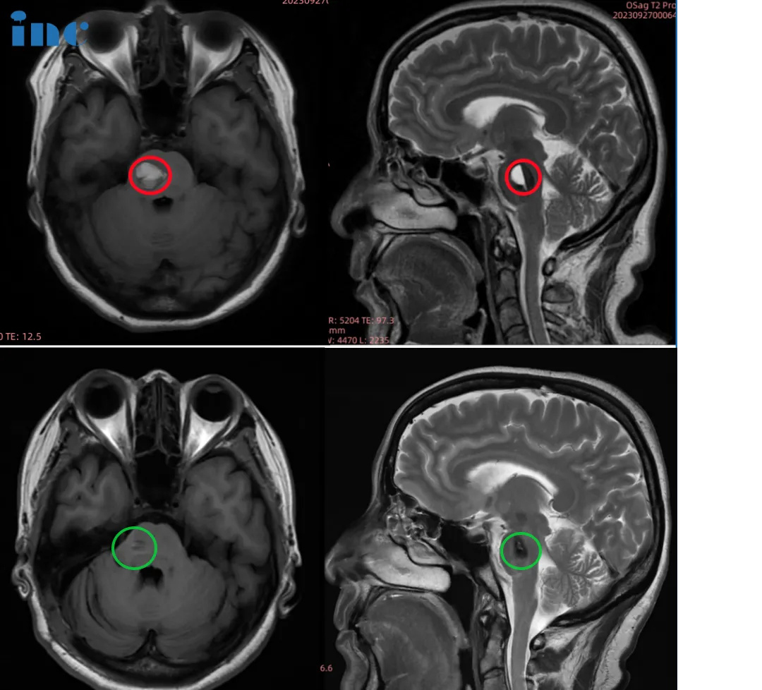 52岁女性—脑干海绵状血管瘤