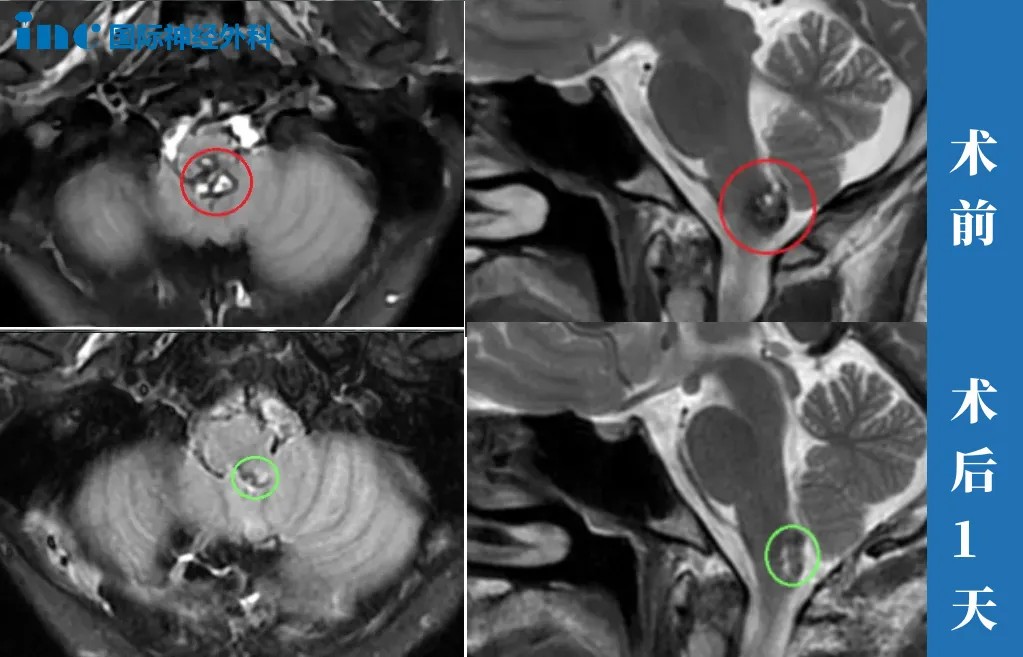 19岁男孩—脑干海绵状血管瘤