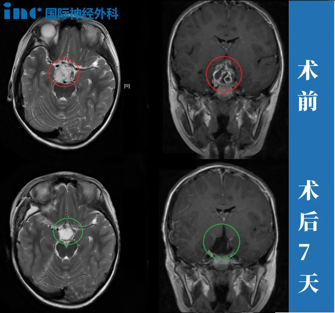 7岁男孩—颅咽管瘤