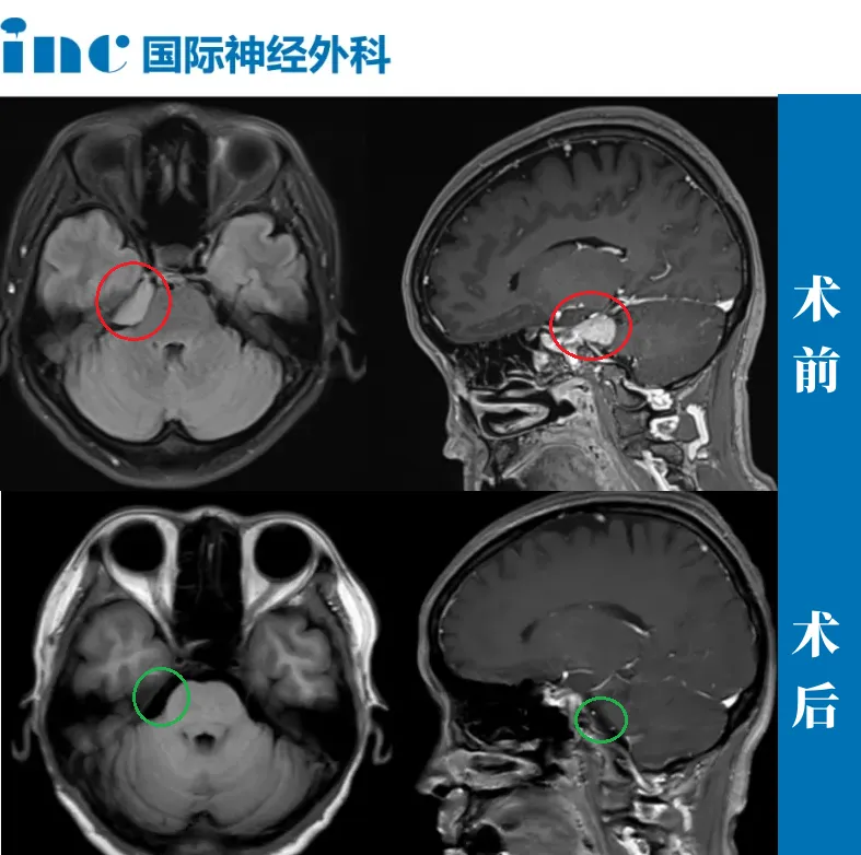 52岁女性—CPA区脑膜瘤
