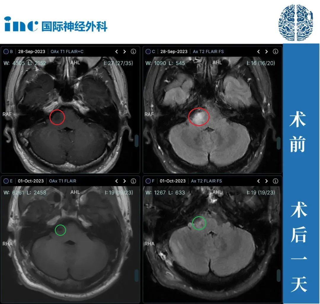 30岁男性—桥臂胶质瘤