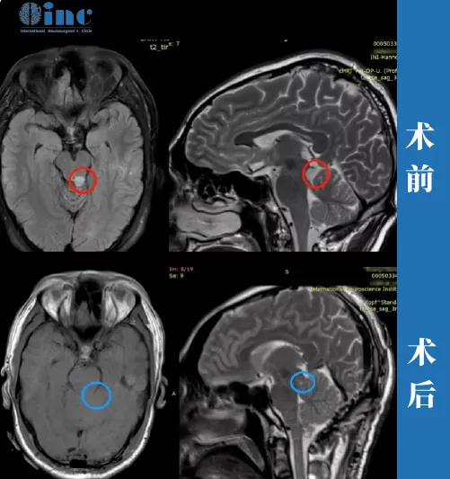 30岁男性—中脑顶盖胶质瘤