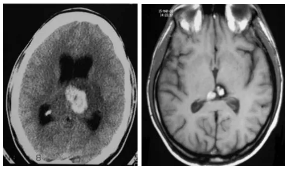 丘脑海绵状血管瘤放疗竟引发出血、形成多处脑血管病变？