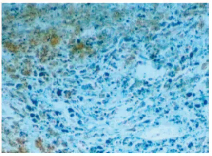 丘脑海绵状血管瘤
