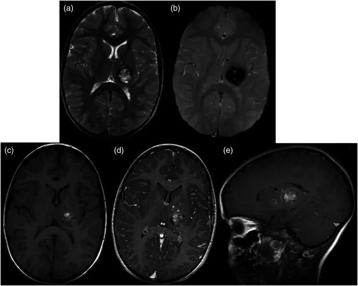 图2：患者5岁时一次就诊时的MRI。