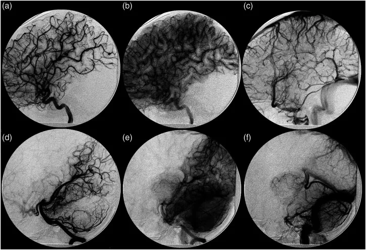 图3：初次就诊时的血管造影。